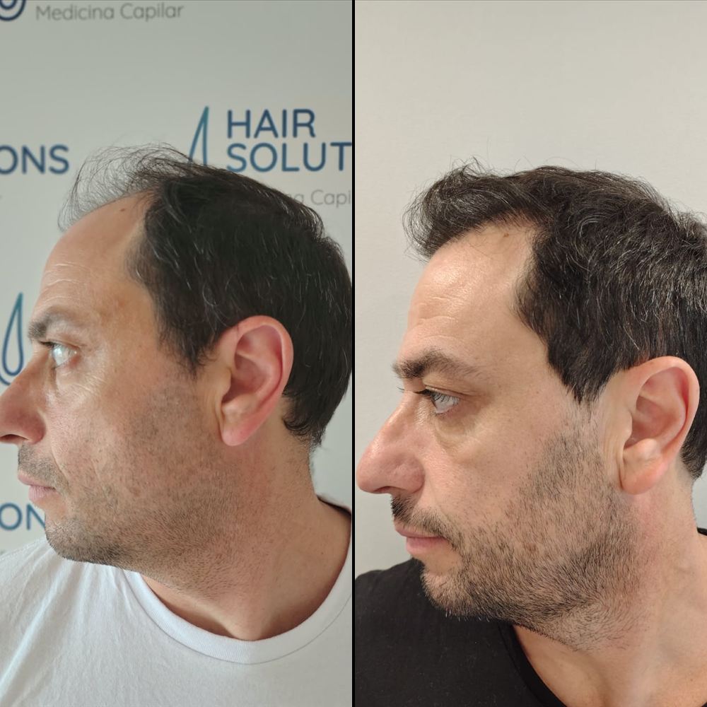 Antes y después de implante capilar, caso 1
