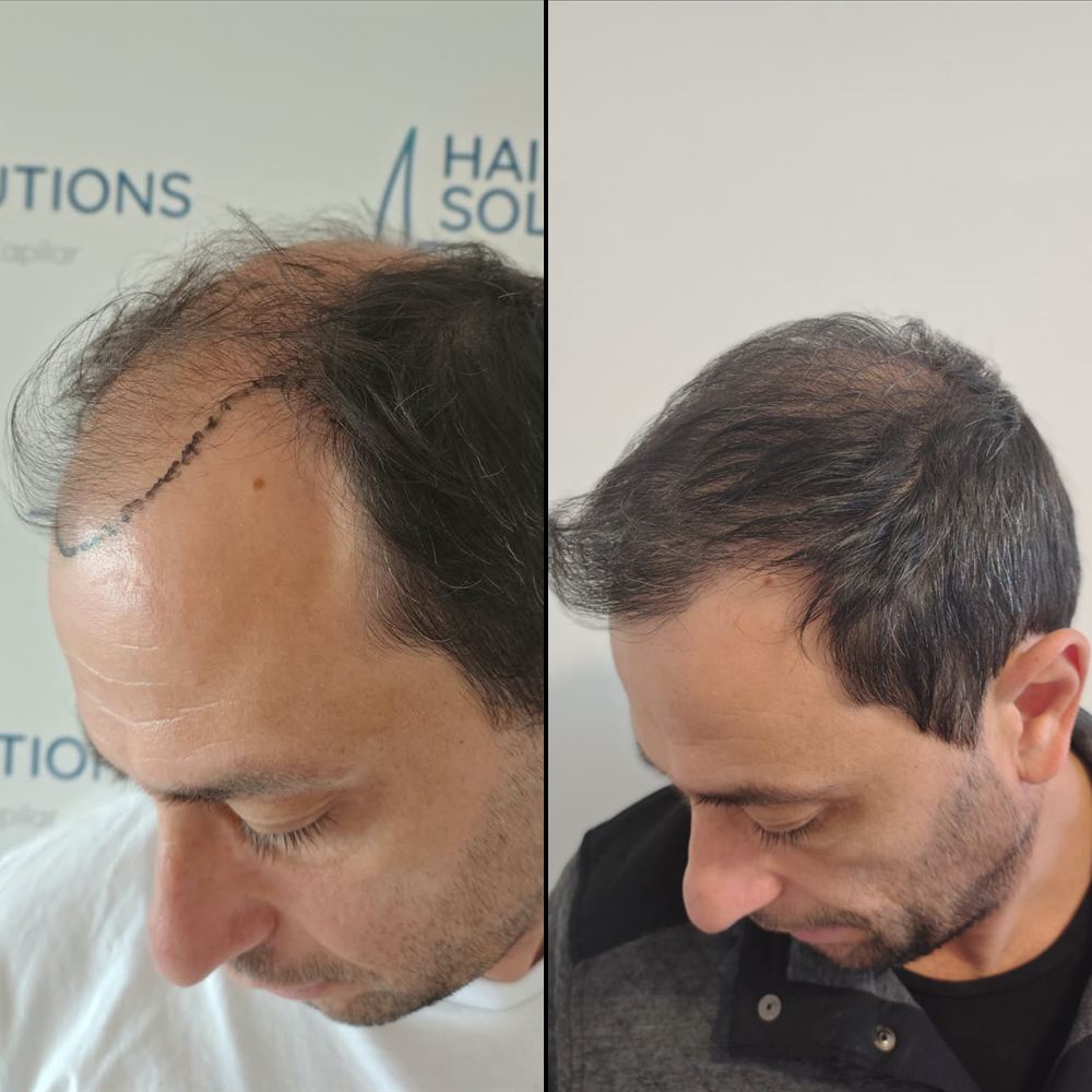 Antes y después de implante capilar, caso 2