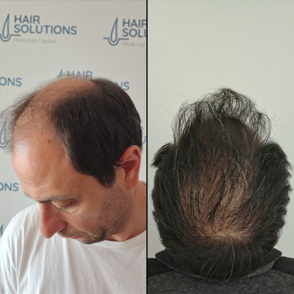 Antes y después de implante capilar, caso 4