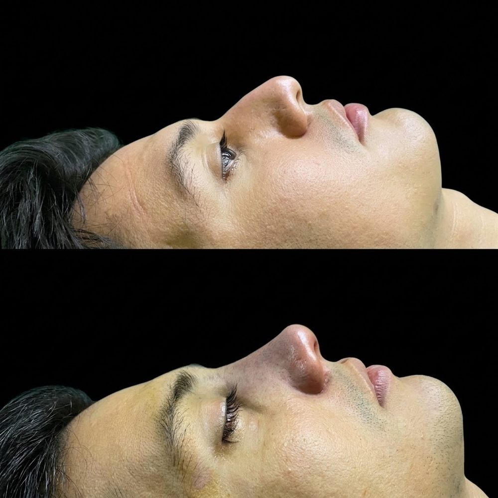 Antes y después de rinoplastia, caso 3