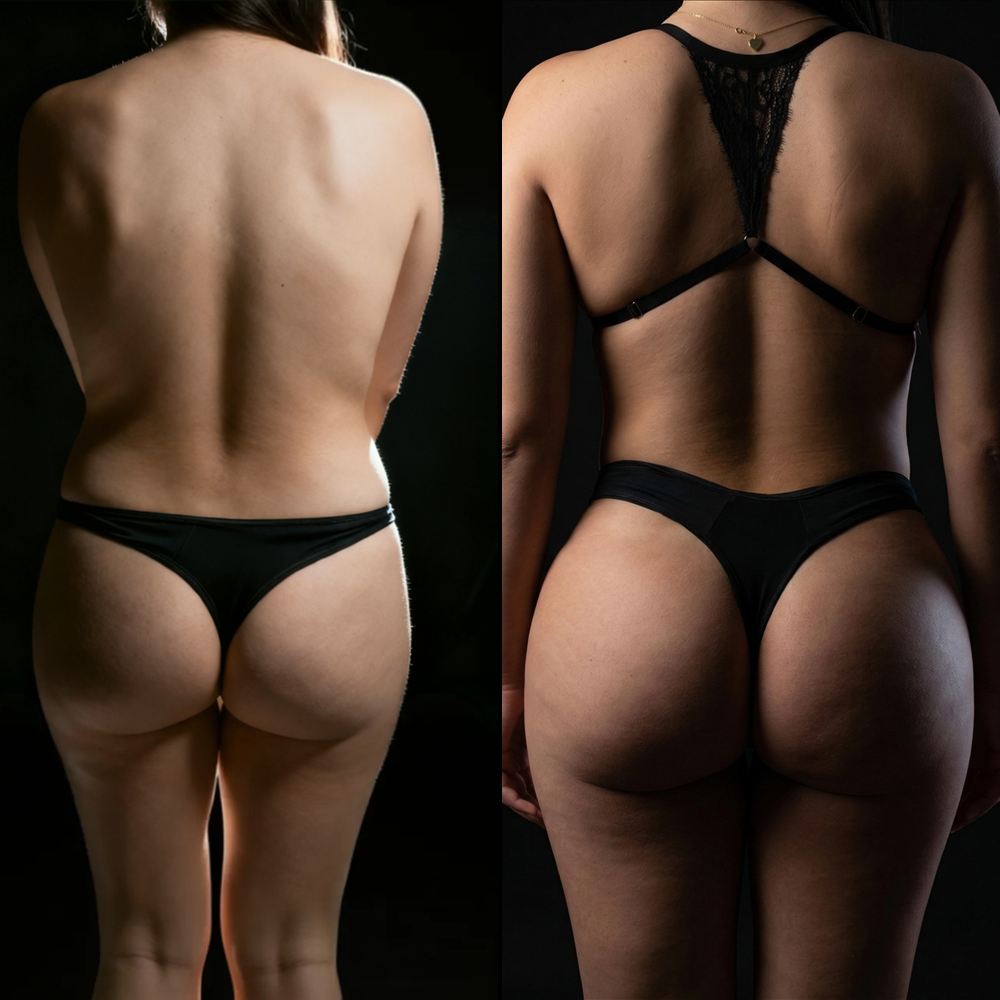 Antes y después de cirugía corporal, caso 2