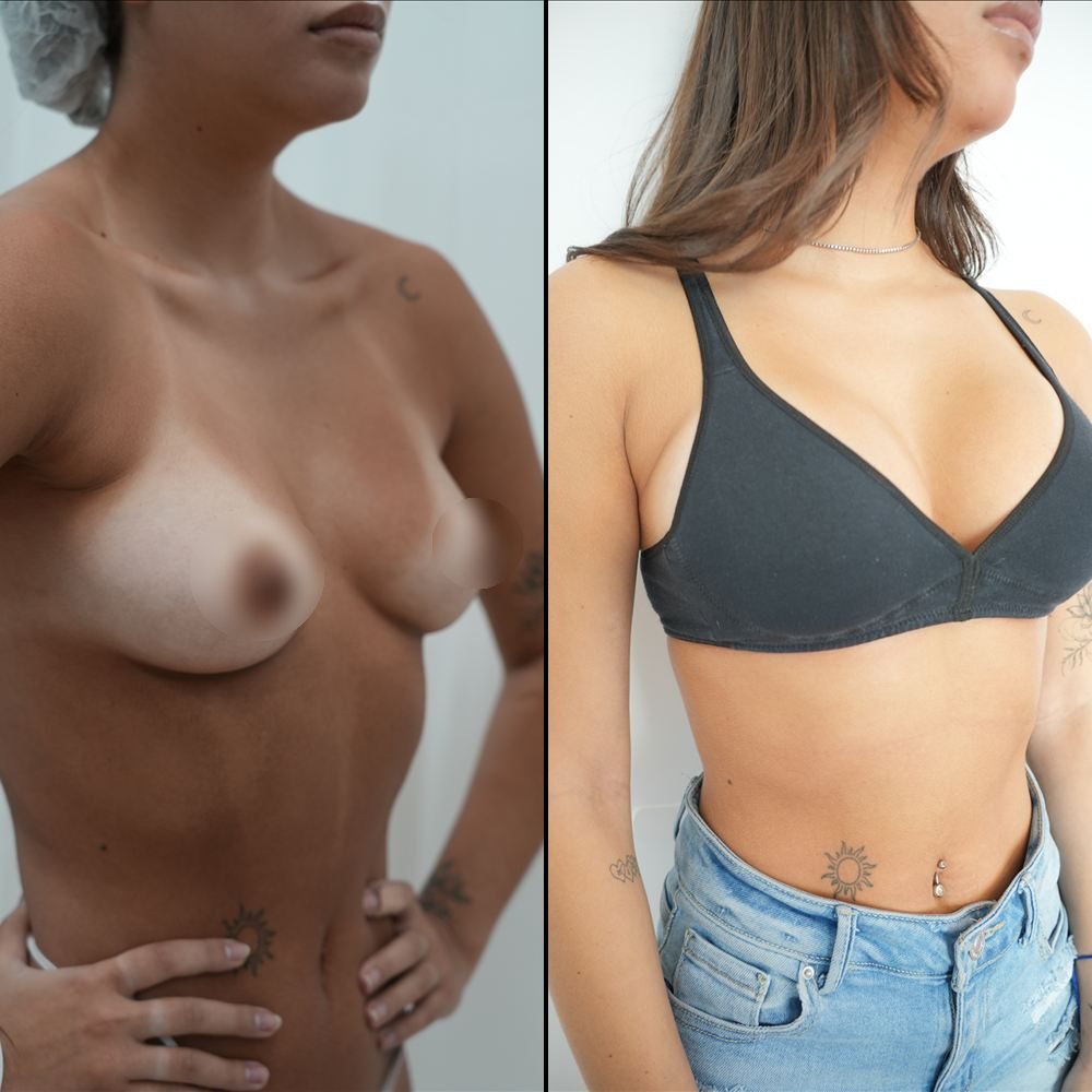 Antes y después de cirugía mamaria, caso 2