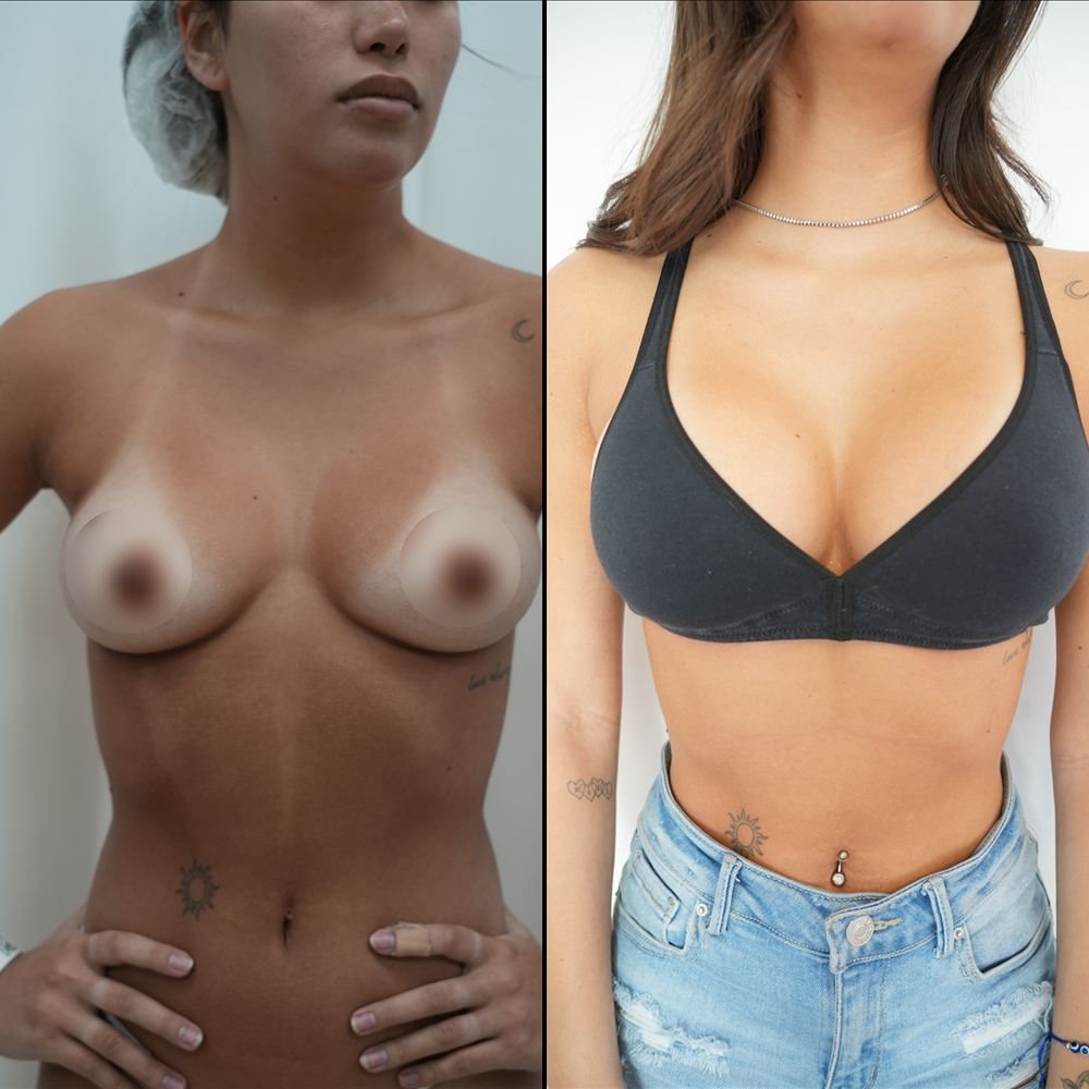 Antes y después de cirugía mamaria, caso 1
