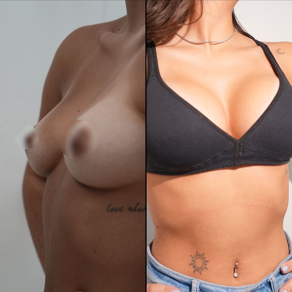 Antes y después de cirugía mamaria, caso 3