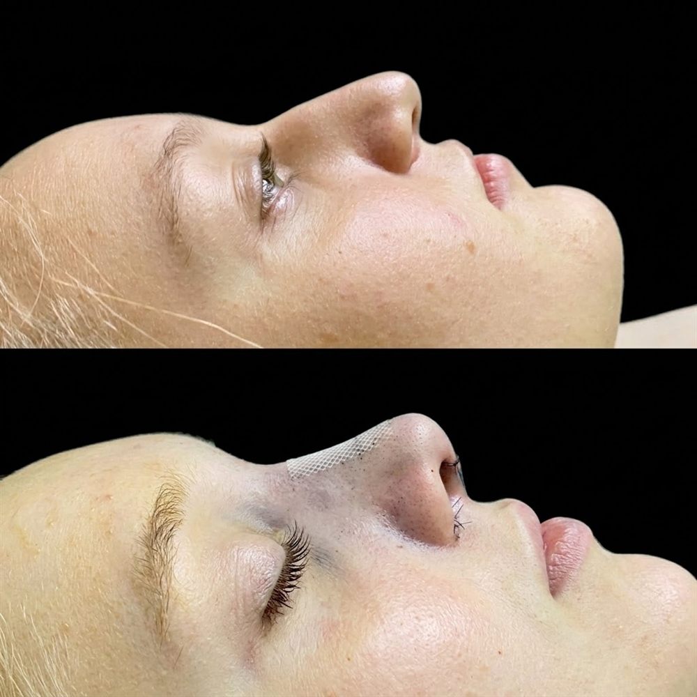 Antes y después de rinoplastia, caso 1