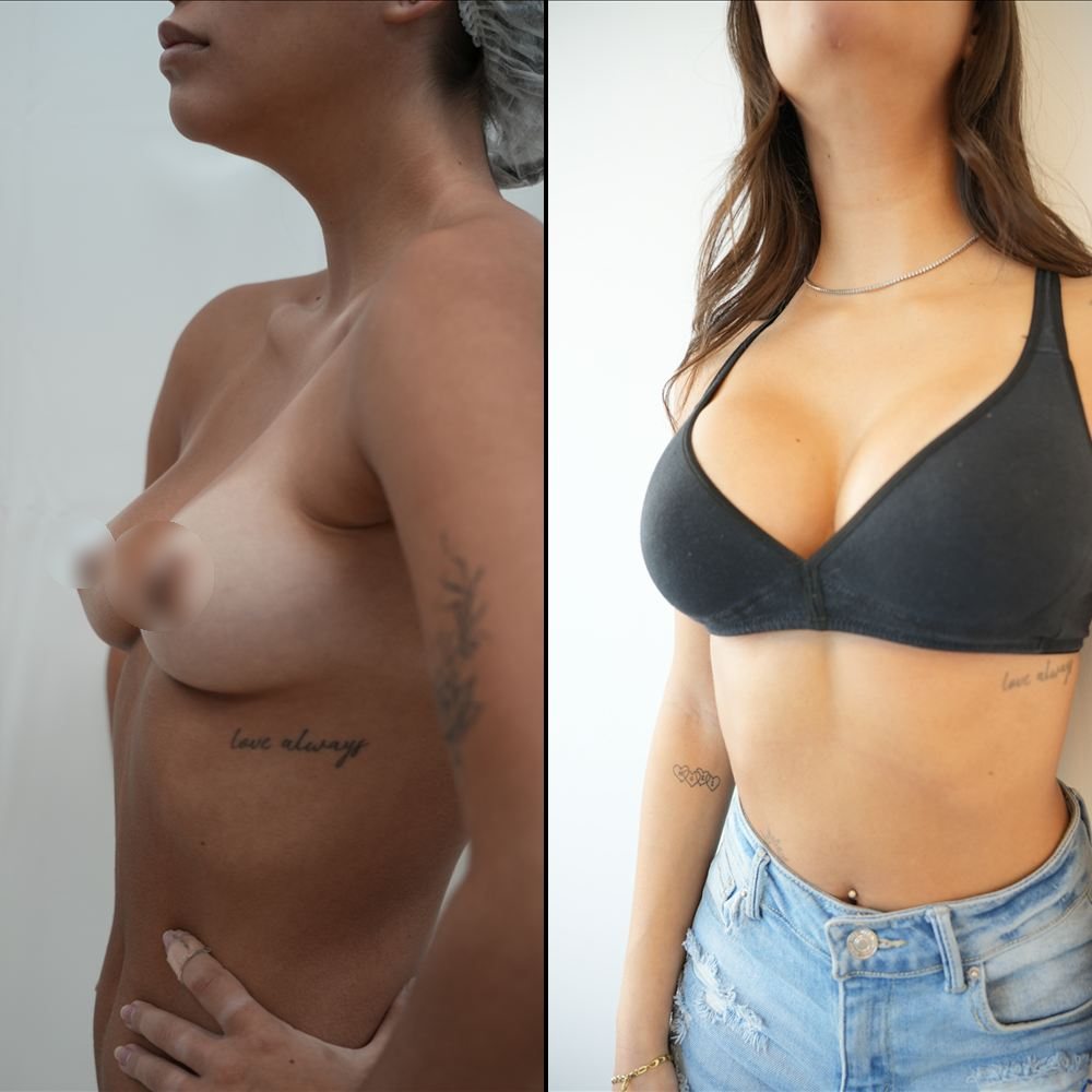 Antes y después de cirugía mamaria, caso 4
