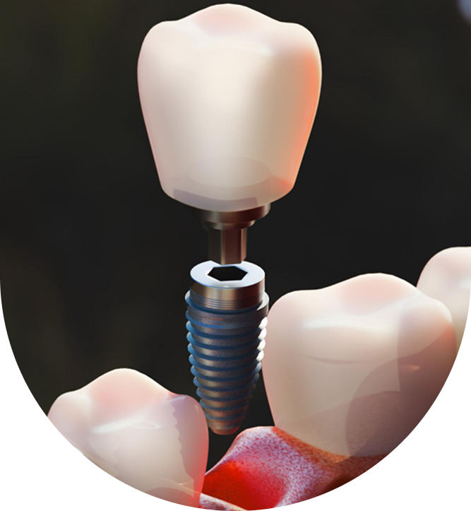 Dental Implants The Modern Solution for Missing or Damaged Teeth
