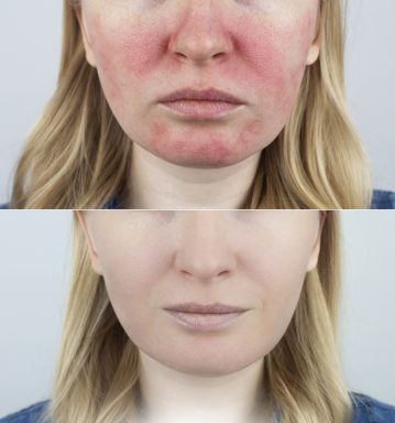 Treat Rosacea in Pueblo, CO