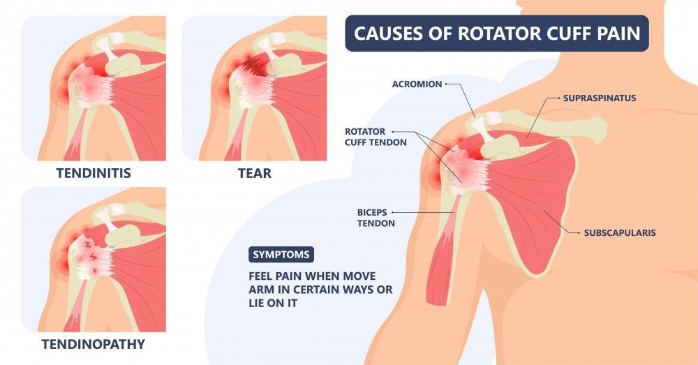 Causes of rotator cuff pain image Causes of rotator cuff pain image