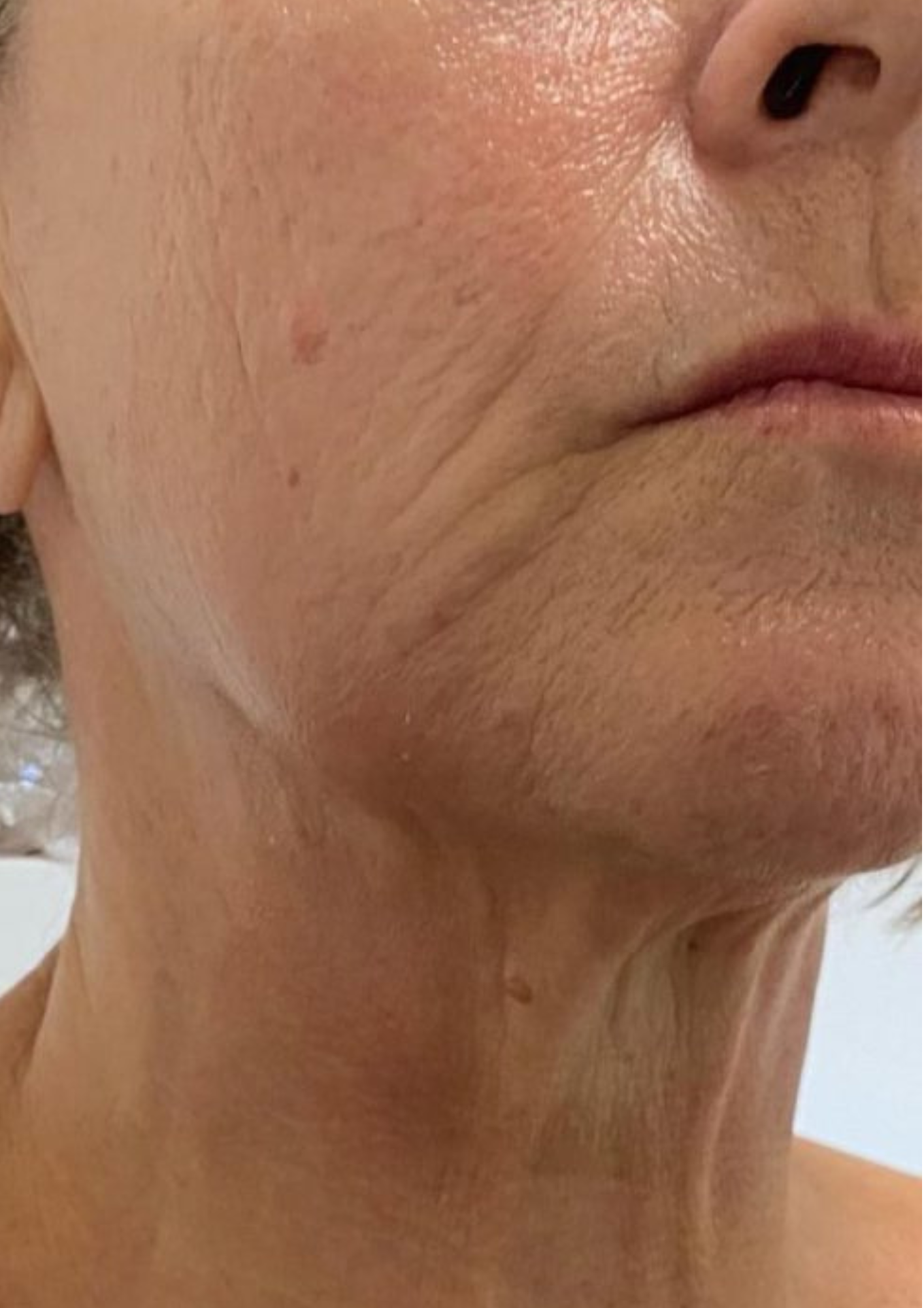 Client after treatment