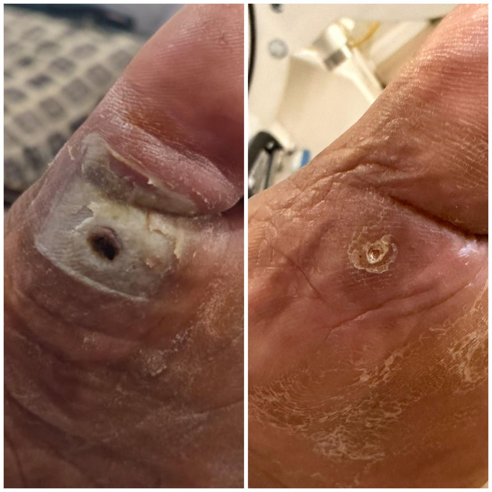 Diabetic foot ulcer before HBOT on the left and after 22 sessions on the right