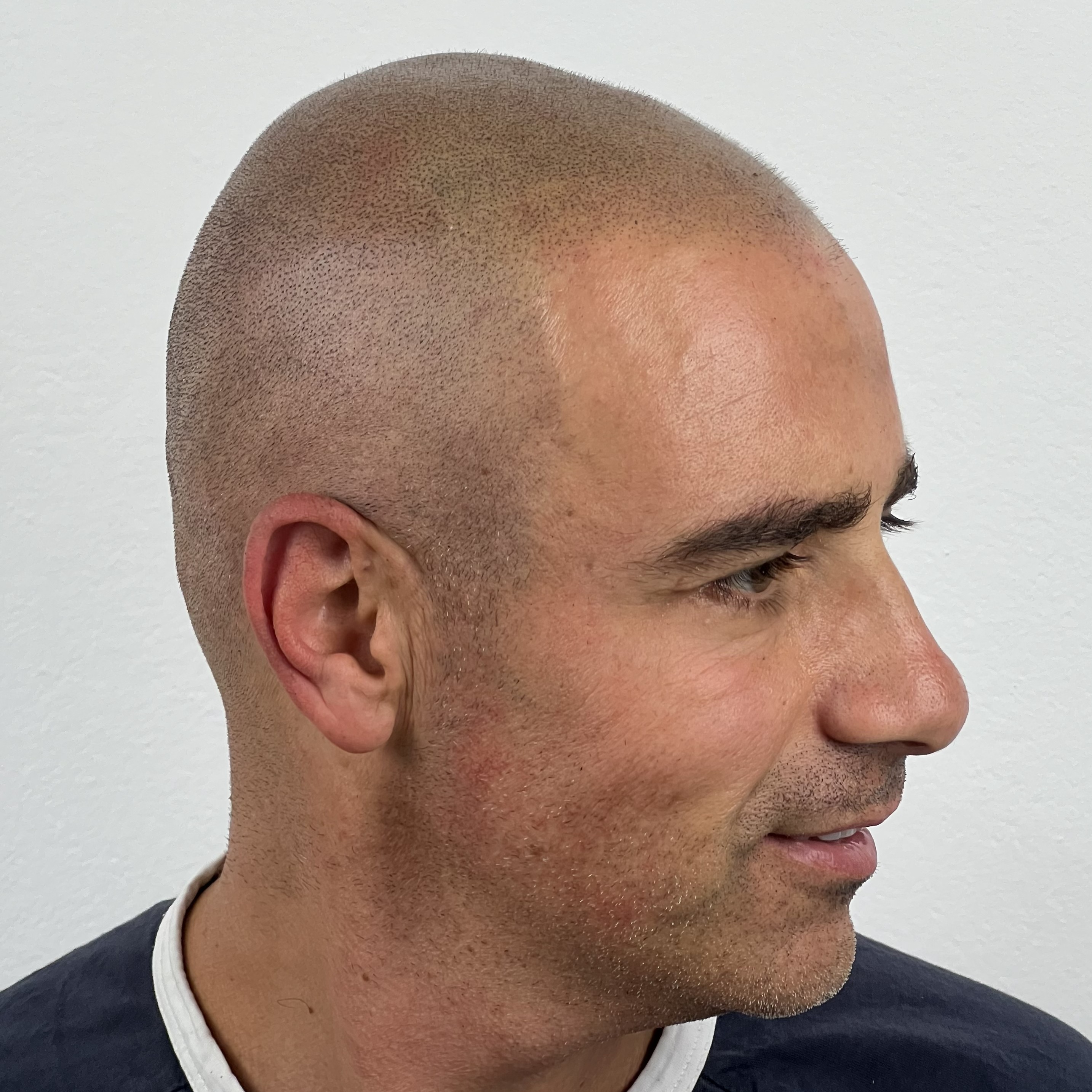 Después micropigmentación capilar