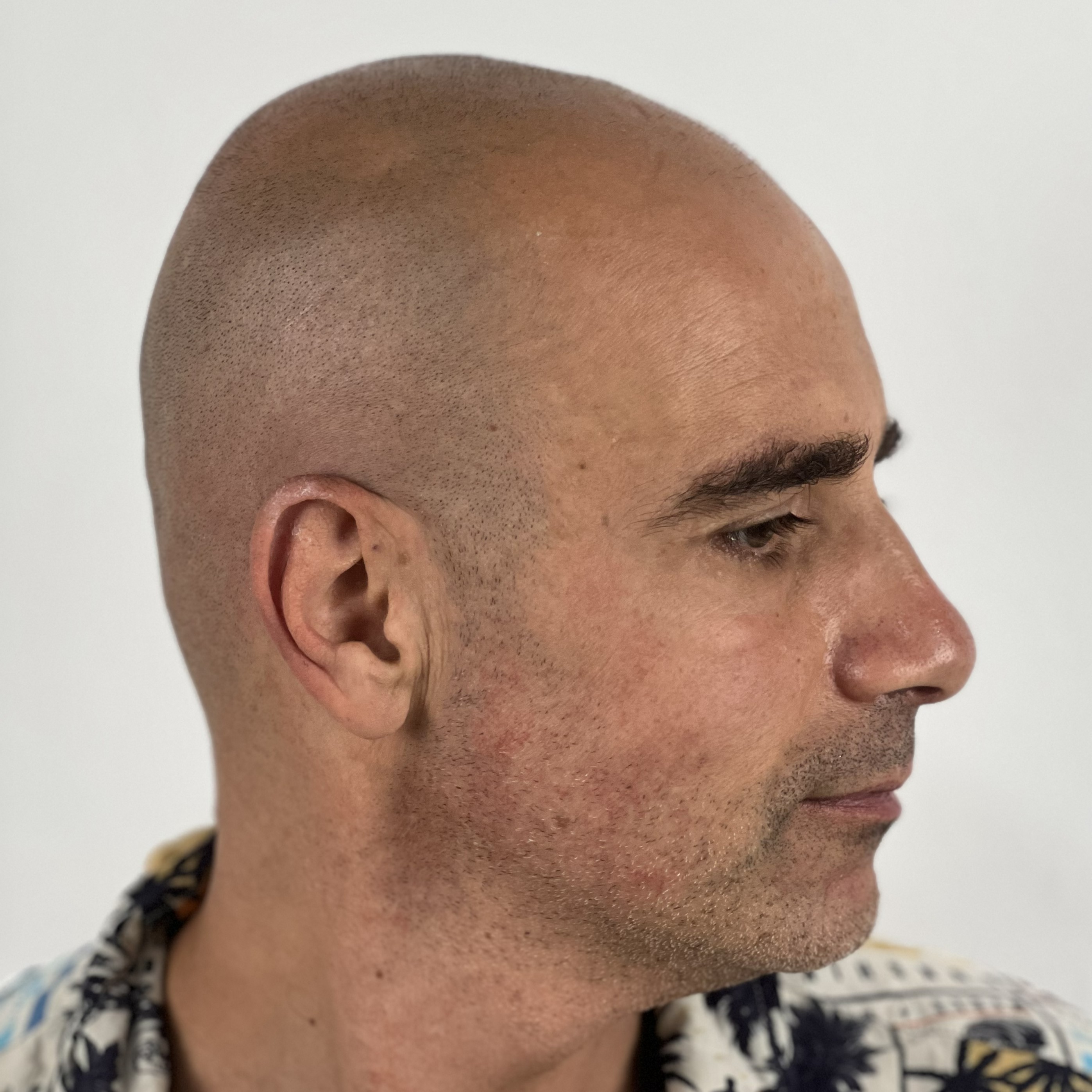 Antes micropigmentación capilar