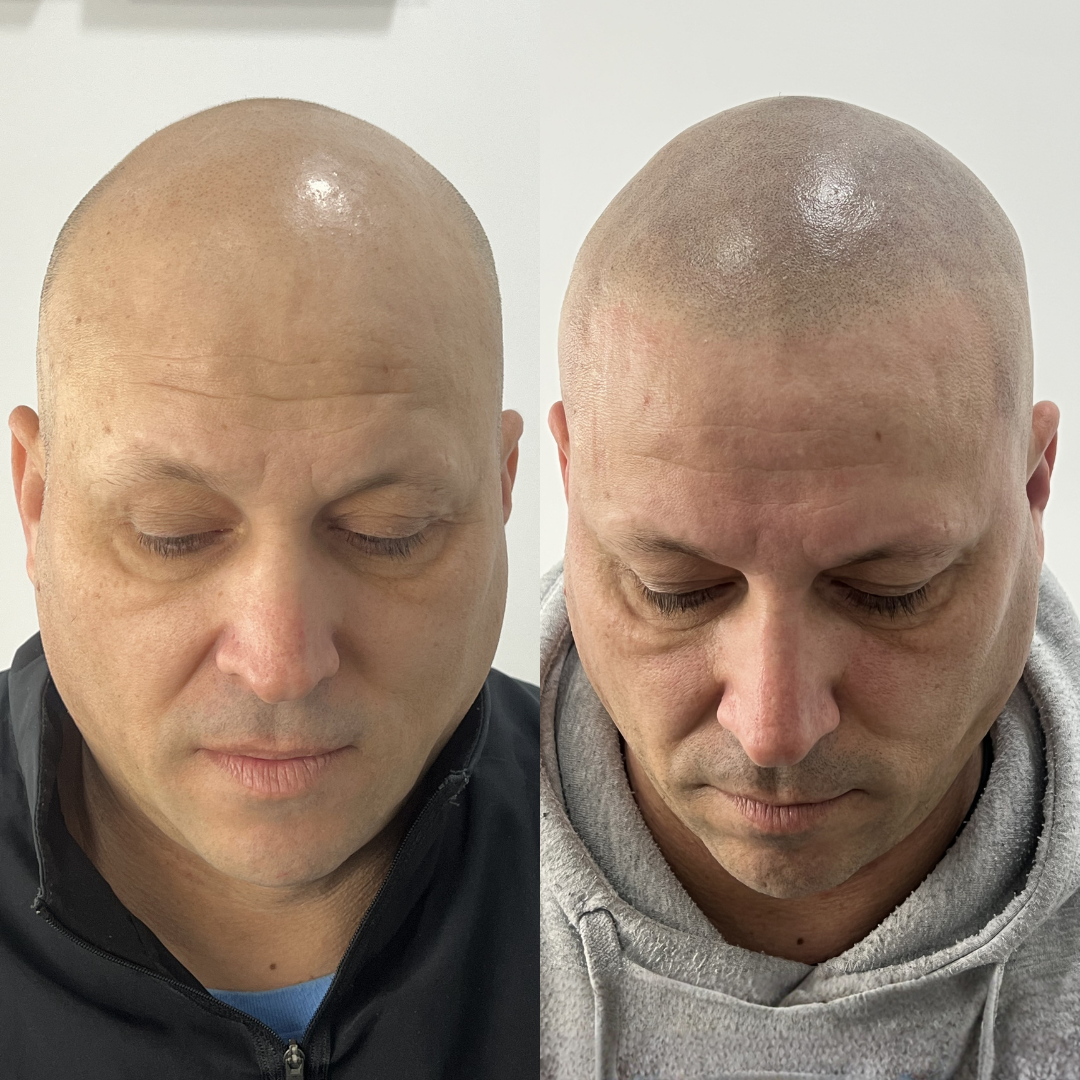 Antes y despues micropigmentacion capilar