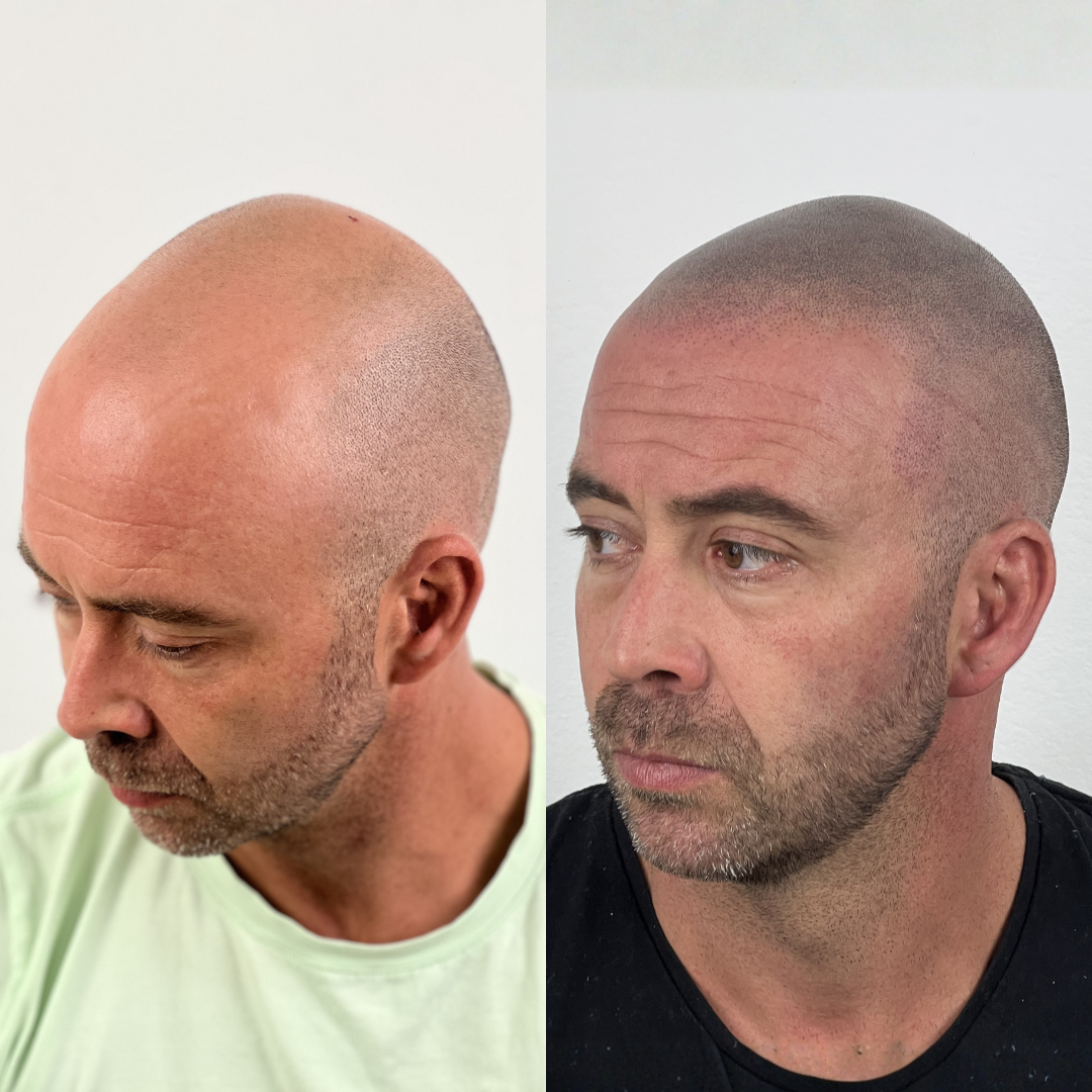 Antes y despues micropigmentacion capilar