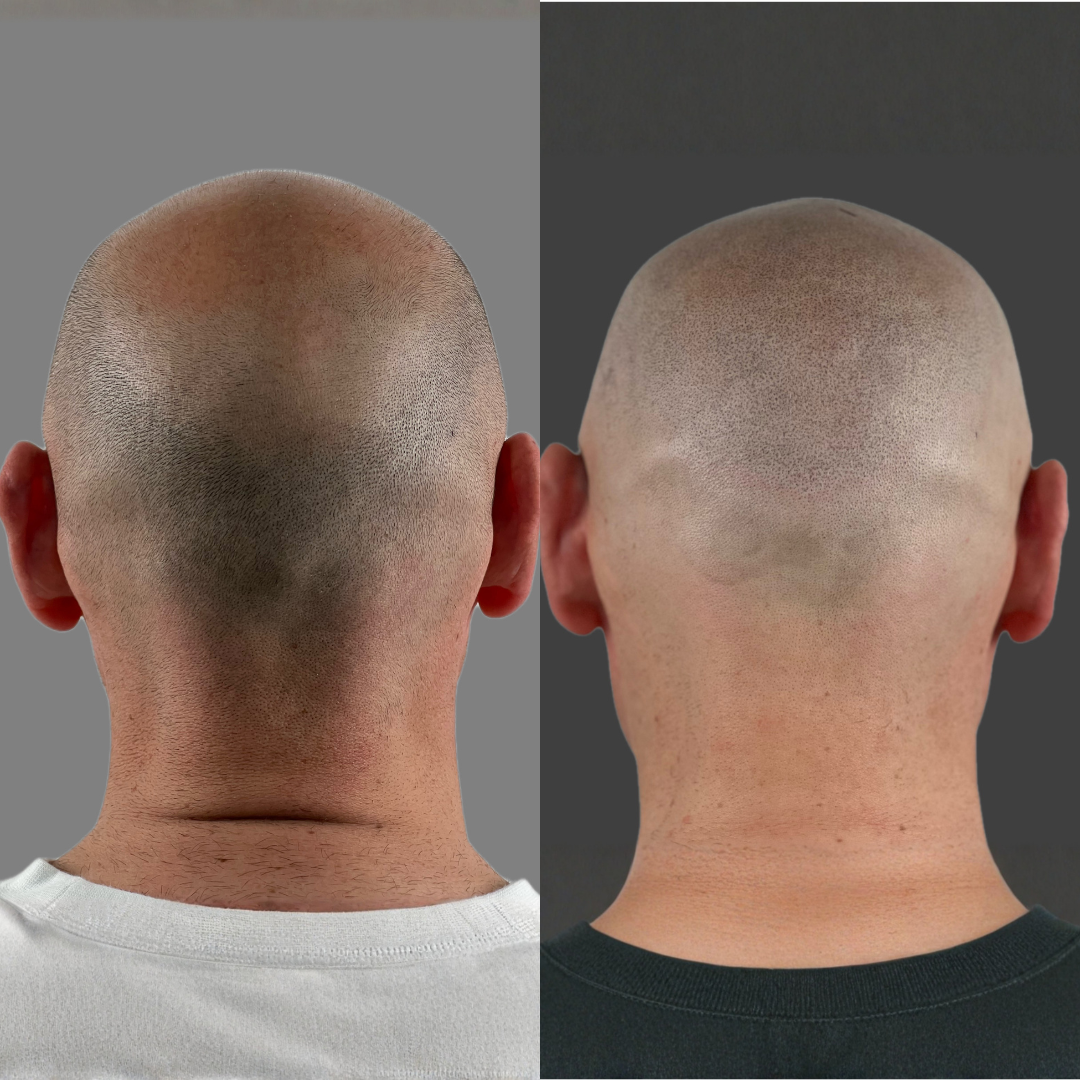 Antes y despues micropigmentacion capilar