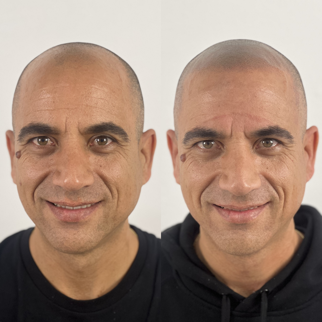 Antes y despues micropigmentacion capilar