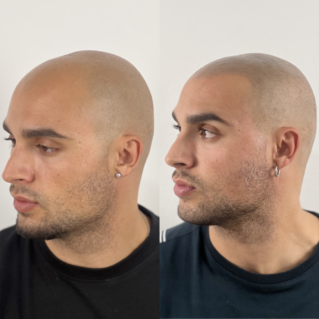 Antes y despues micropigmentacion capilar