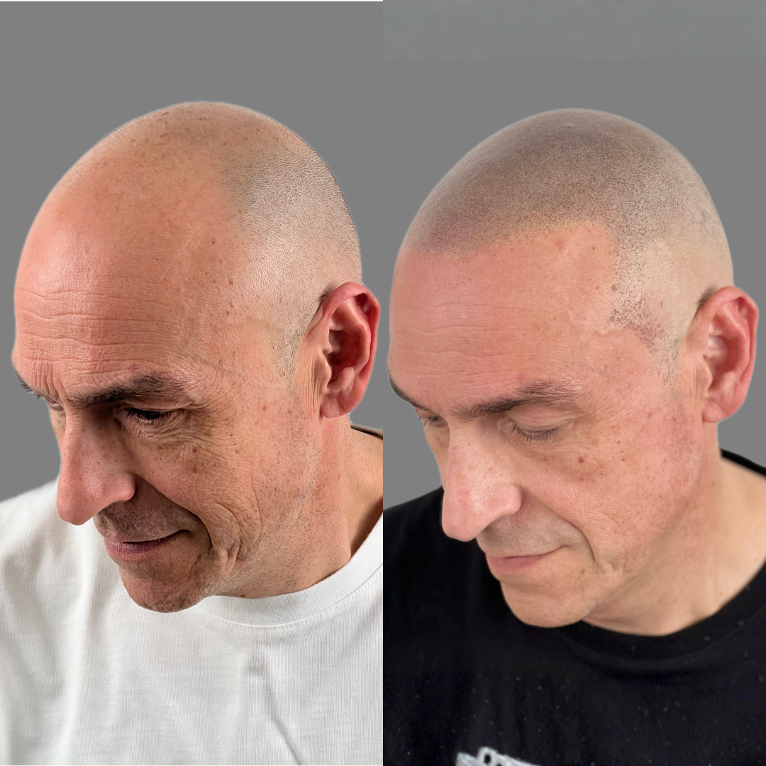 Antes y despues micropigmentacion capilar