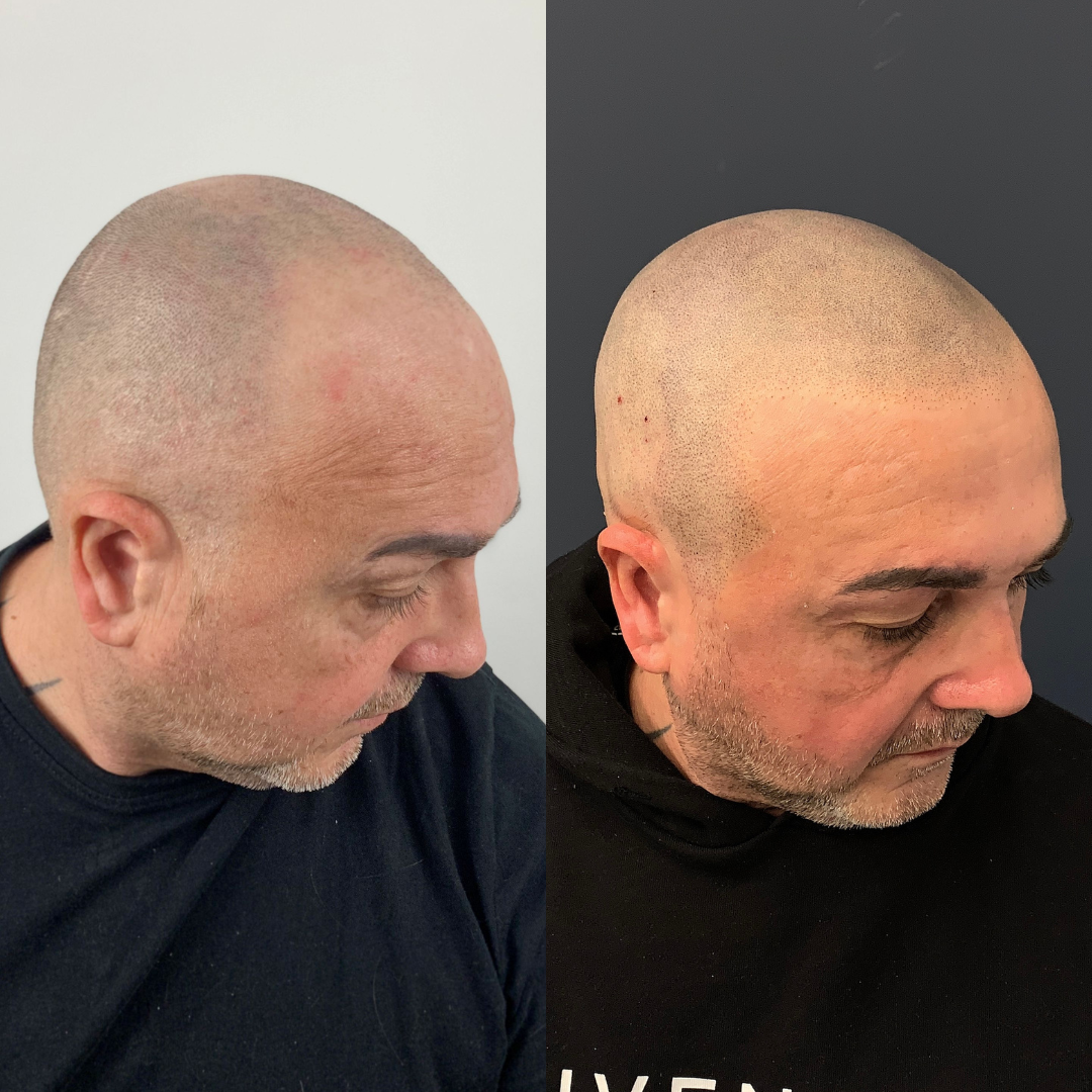 Antes y despues micropigmentacion capilar