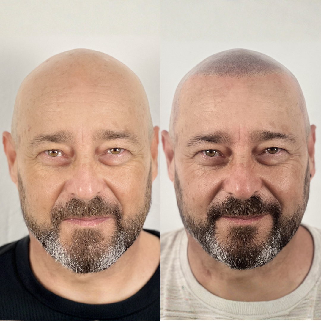Antes y despues micropigmentacion capilar