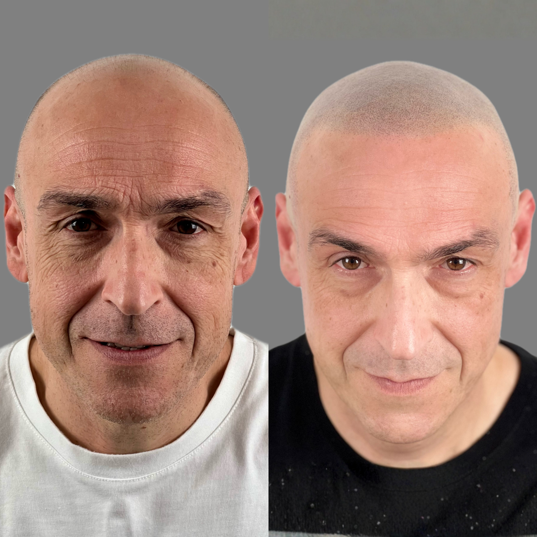 Antes y despues micropigmentacion capilar
