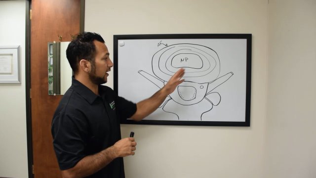 Disc Herniations, Sciatica, & Nerve Compression Explained