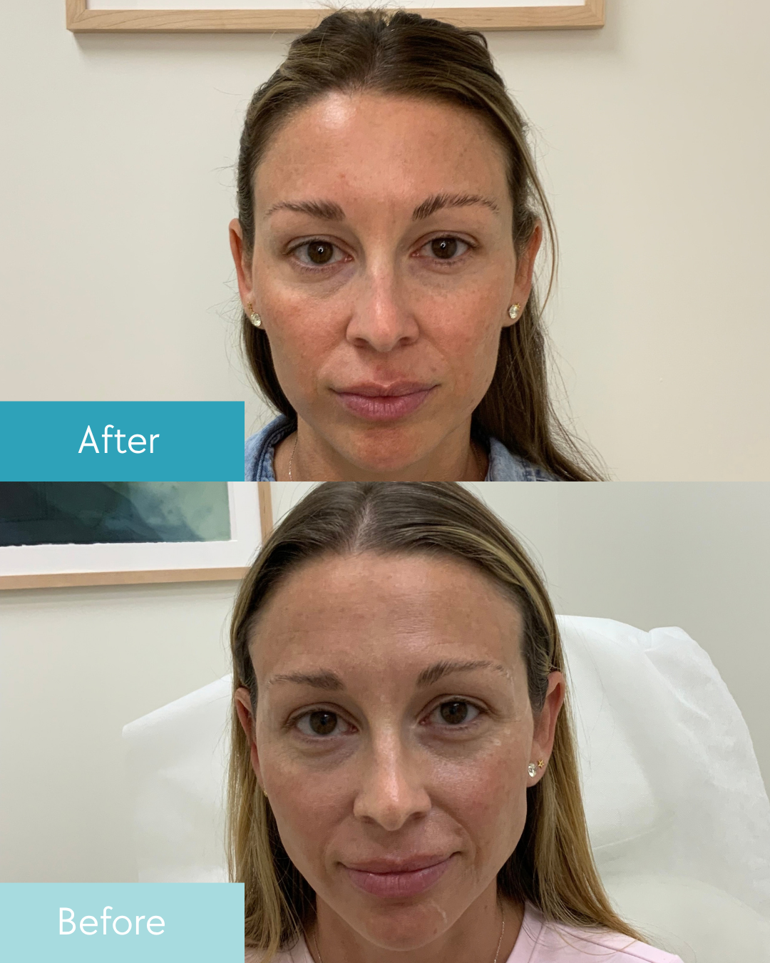 Lip enhancement before and after