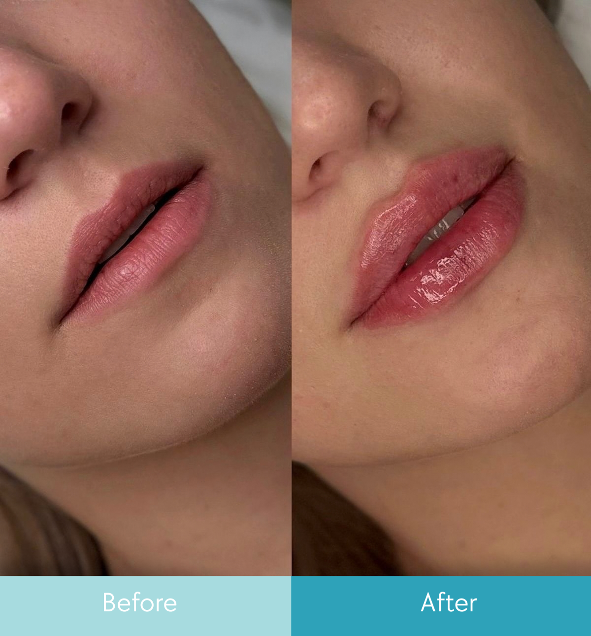 Wrinkle relaxer before and after