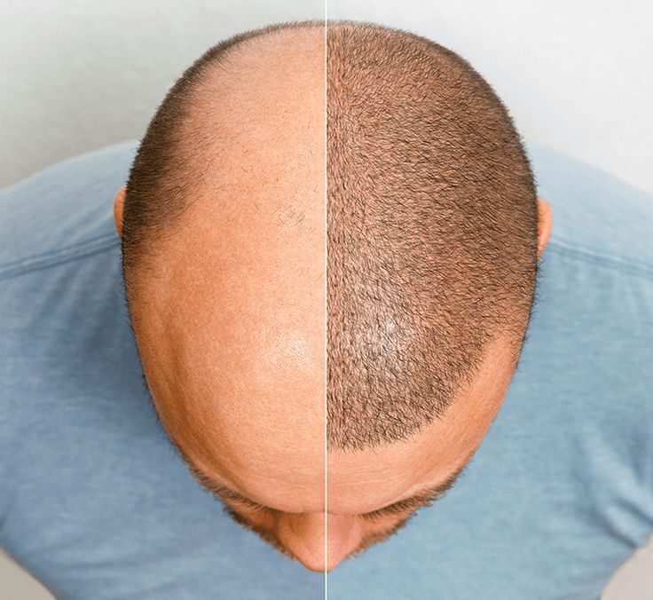 Benefits Of Hair Transplant Over Other Treatment