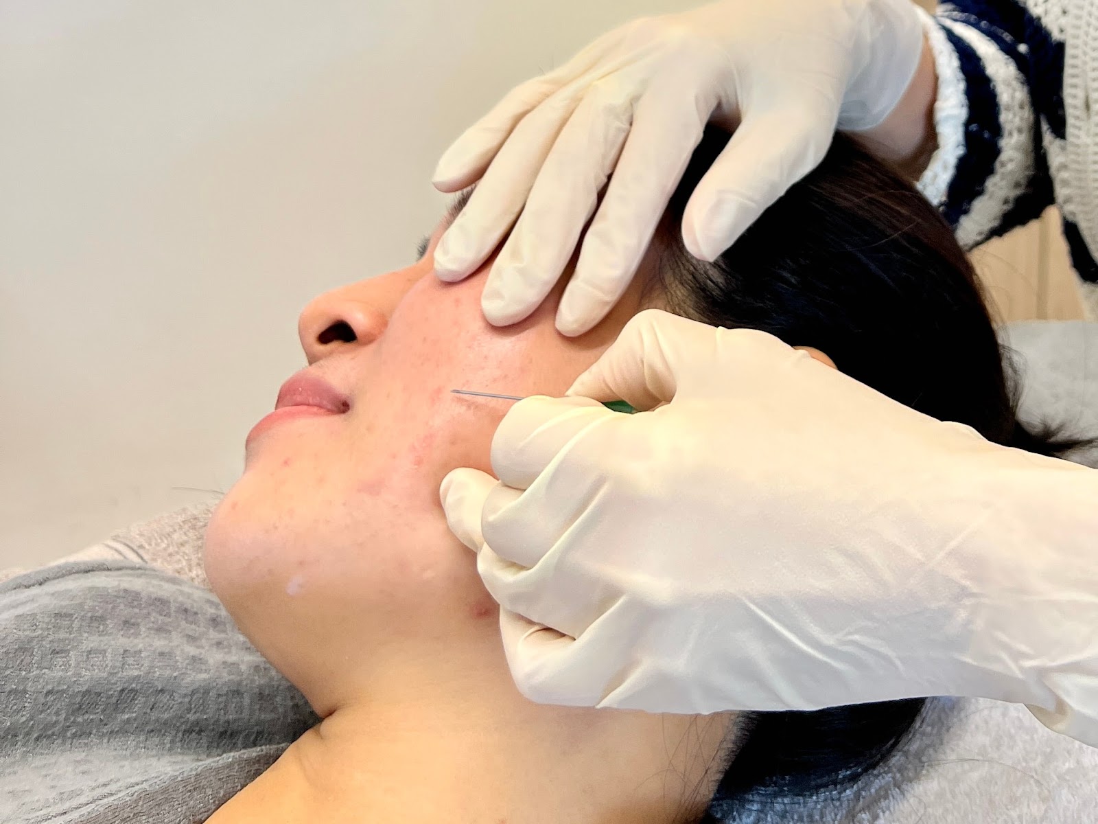Subcision Treatment