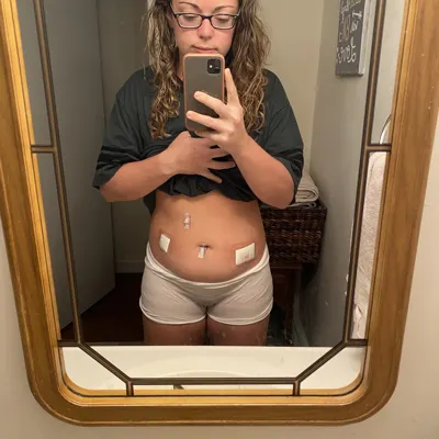 Jen in 2021, a bathroom mirror selfie in glasses showing the bandages on her stomach after excision surgery