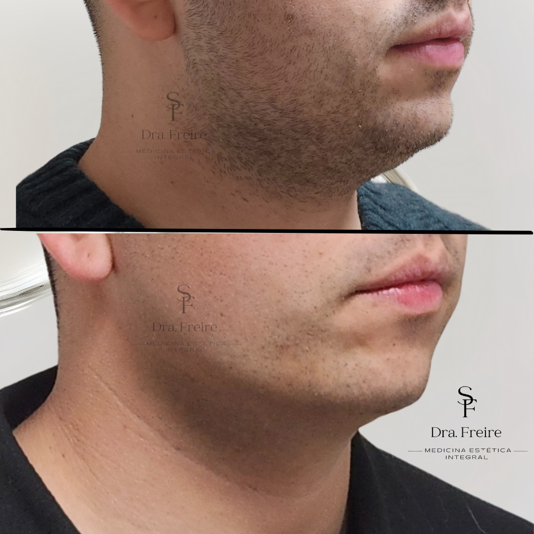 Lipo papada antes y después