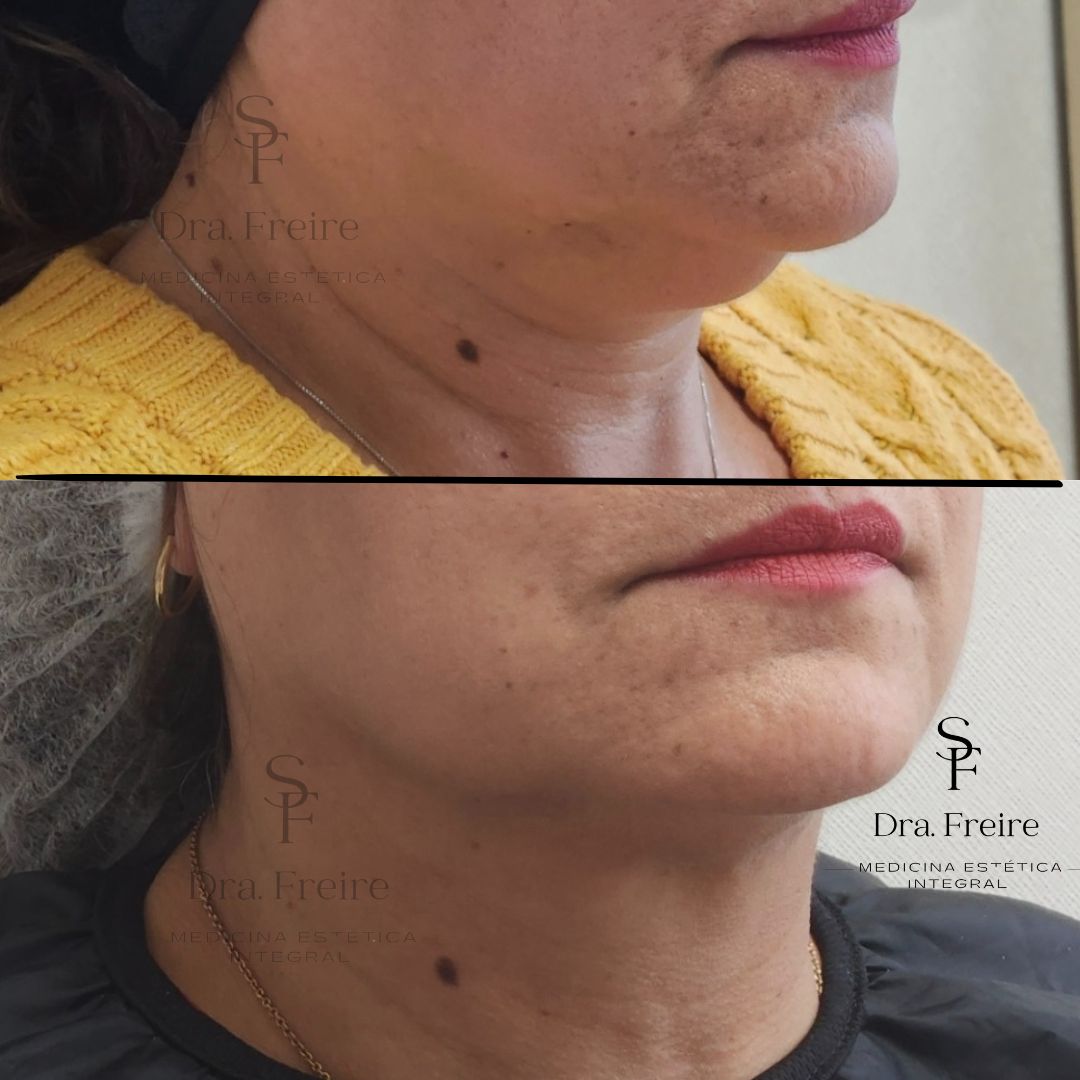 Lipo papada enzimática antes y después
