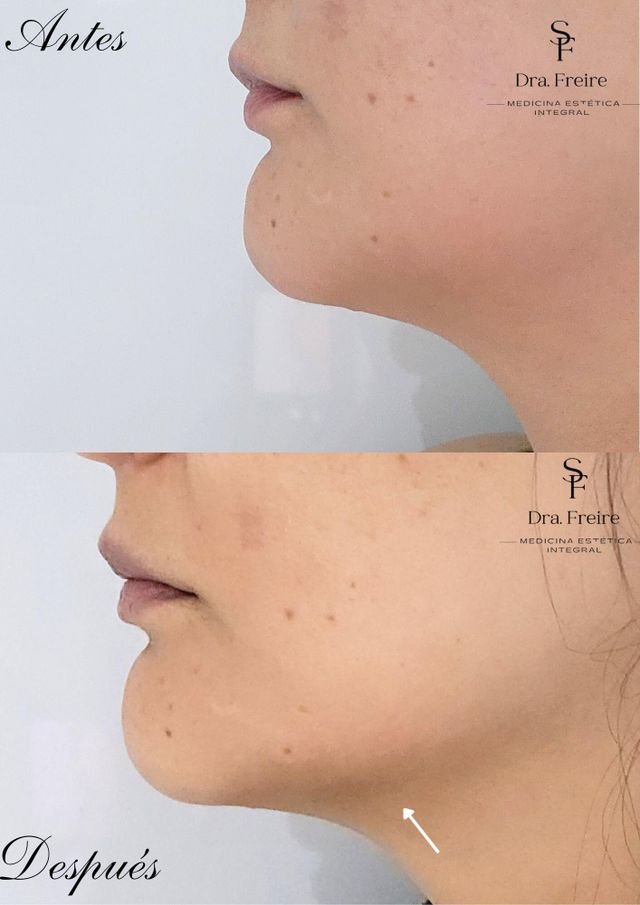 Lipo papada antes y después, vista de perfil