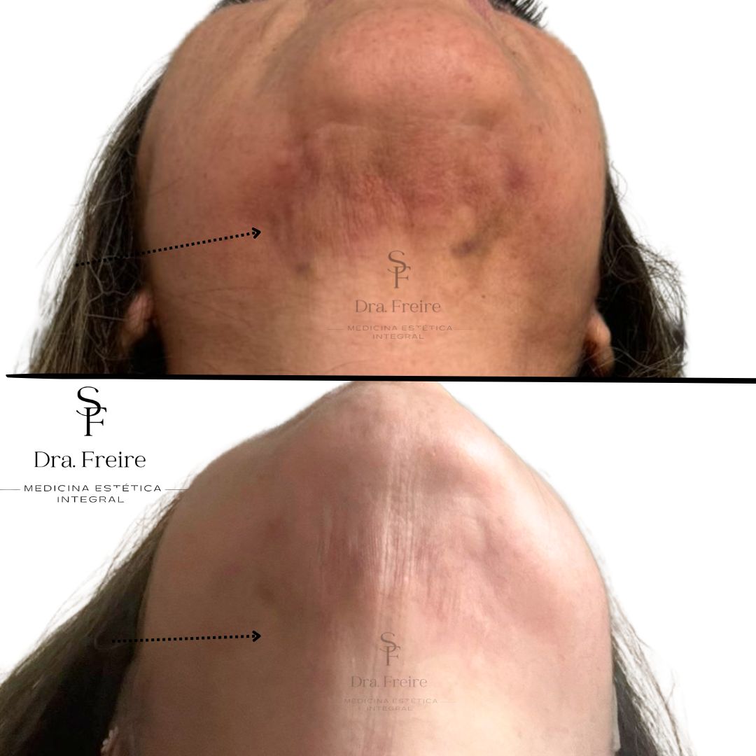 Anti fibrosis facial antes y después