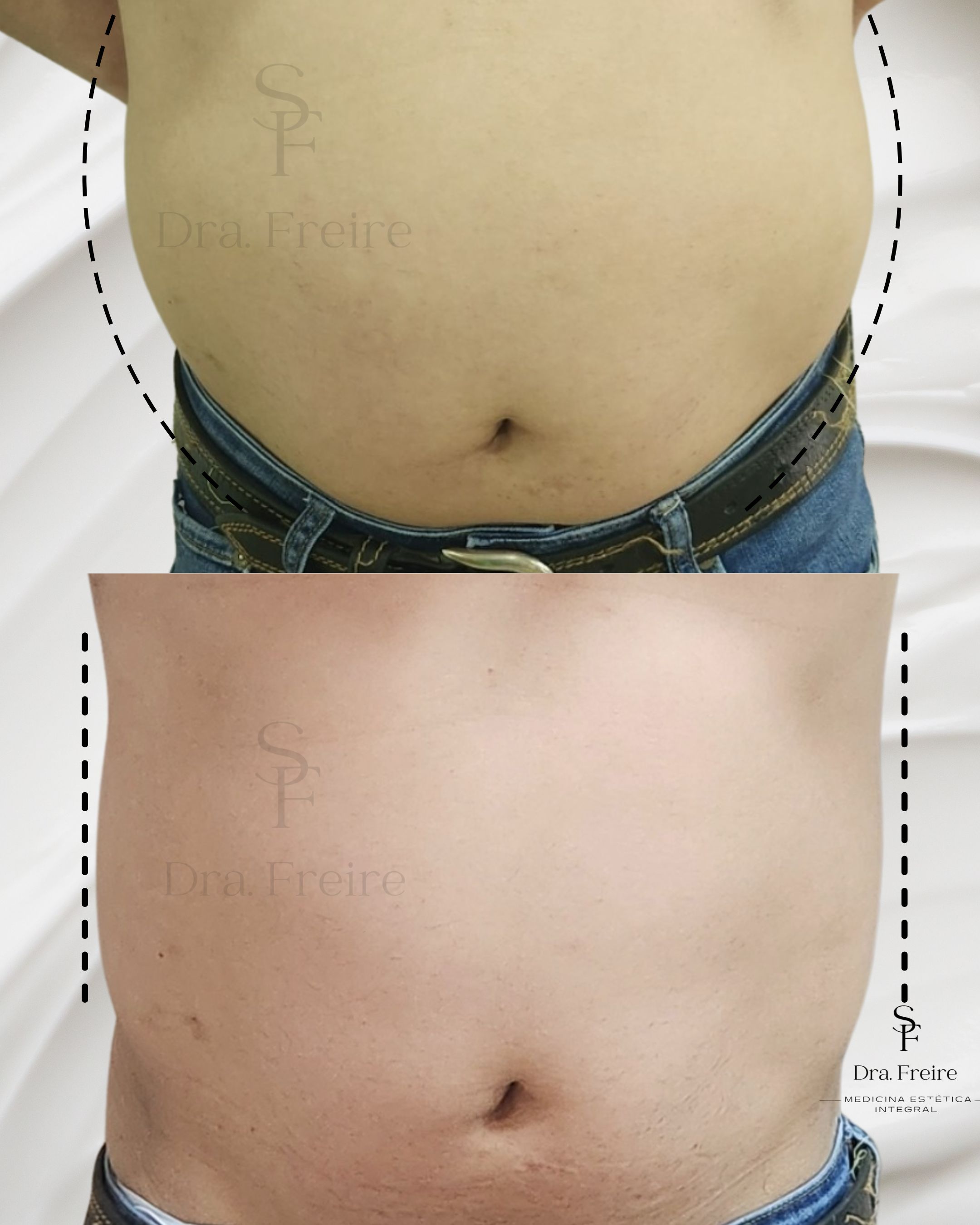 Lipoescultura enzimática antes y después