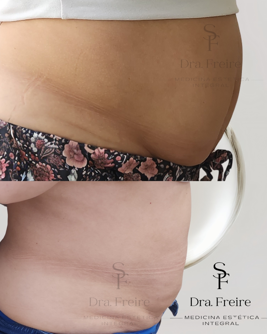 Lipoescultura enzimática antes y después