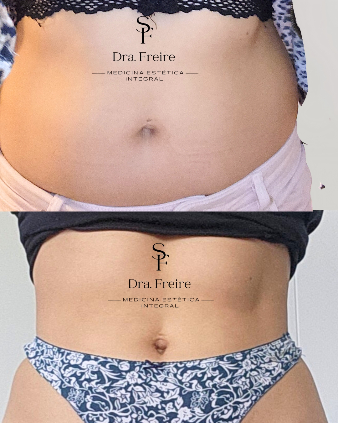 Lipoescultura enzimática antes y después