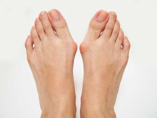 Foot_Bunions