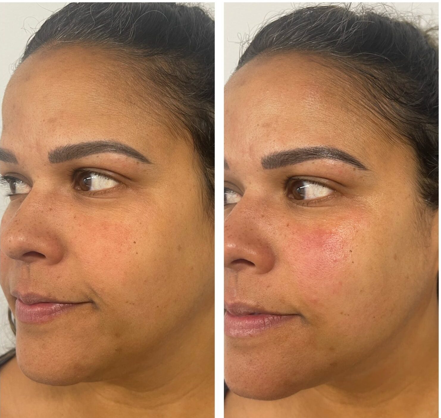 HIFU face lifting before and after result 1