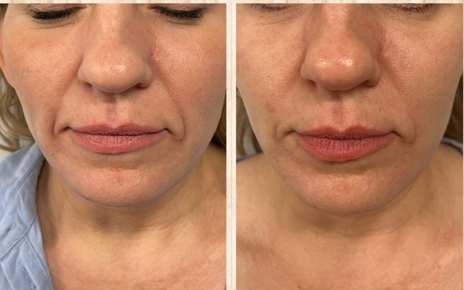 HIFU face lifting before and after result 2