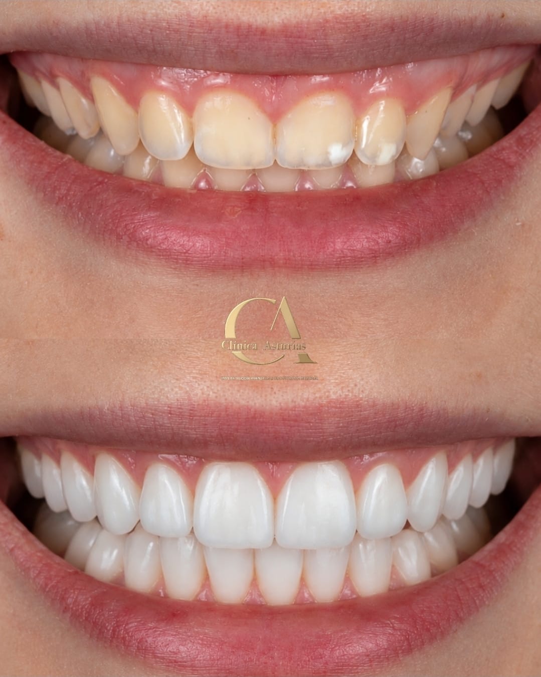 Caso real de diseño de sonrisa en Clínica Asturias