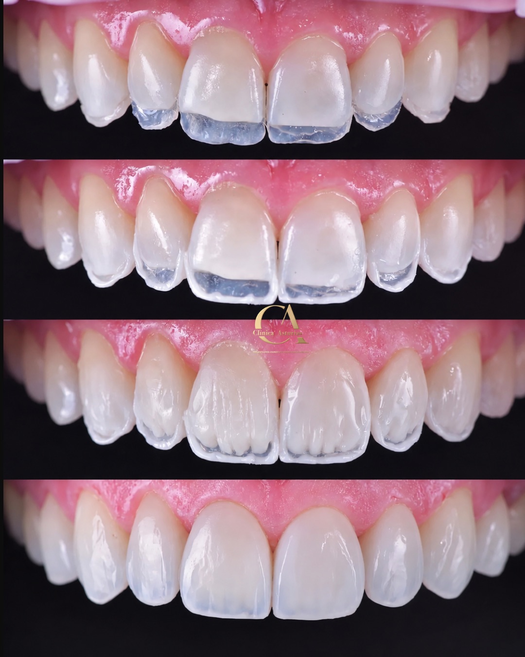 Caso real de diseño de sonrisa en Clínica Asturias, paso a paso