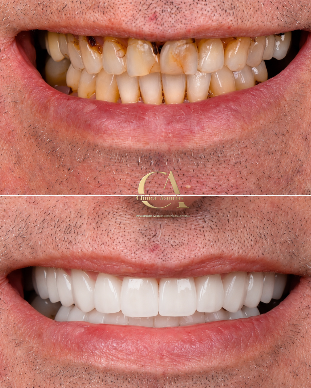 Caso real de diseño de sonrisa en Clínica Asturias