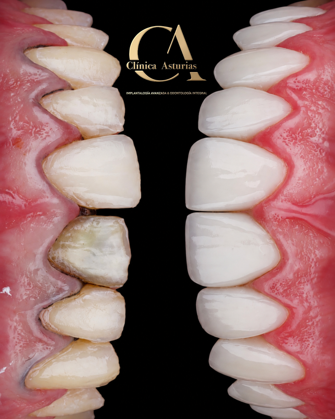 Caso real de diseño de sonrisa en Clínica Asturias