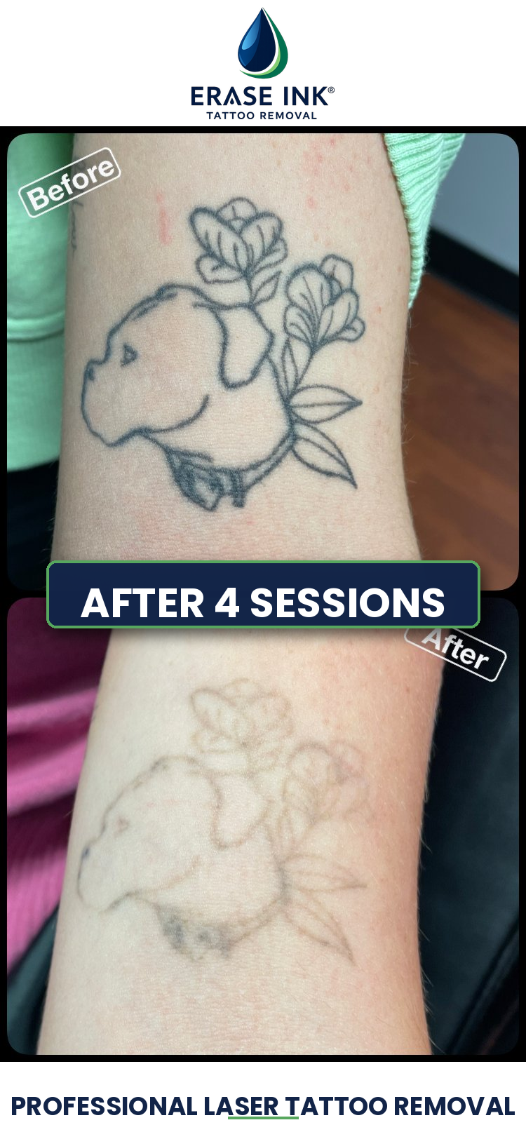 Tattoo removal near Clarkston