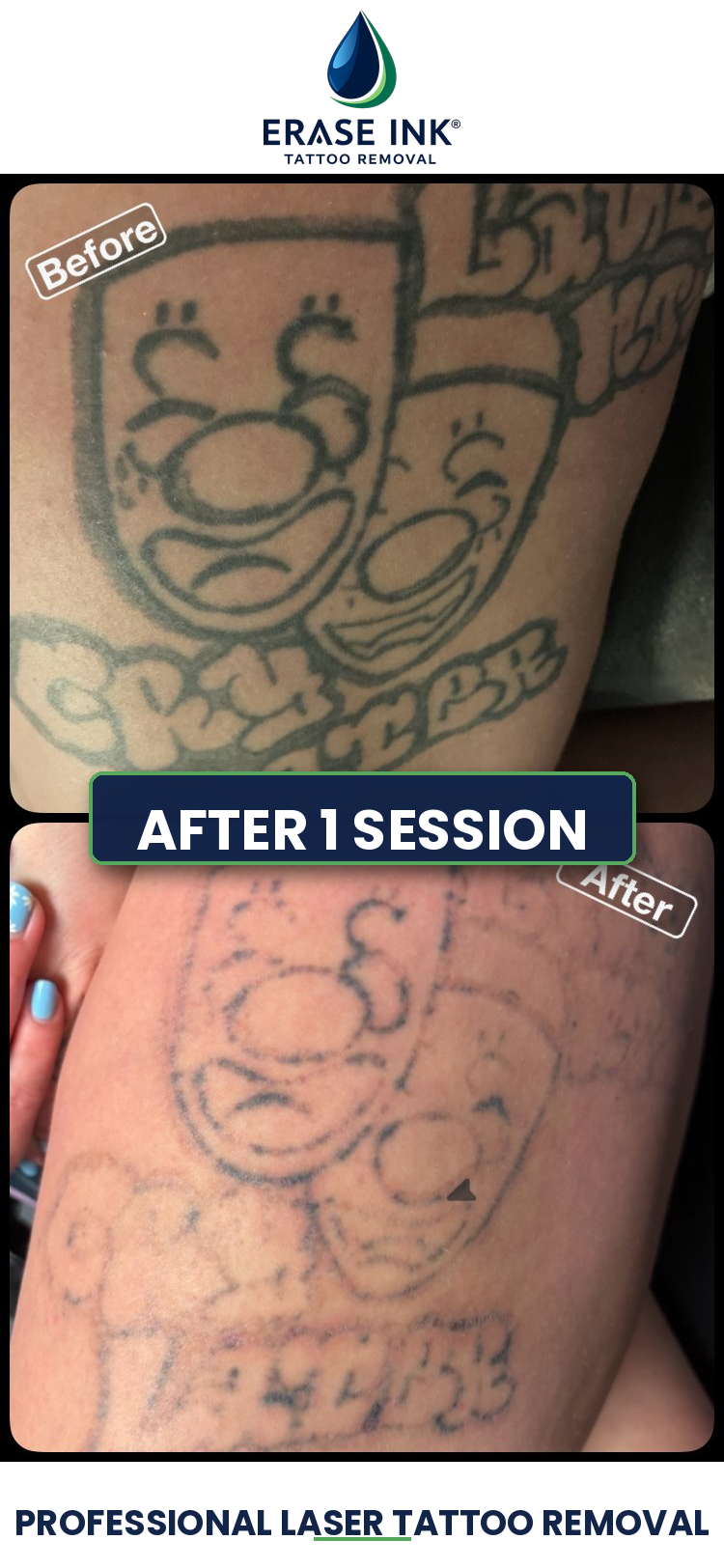 Tattoo removal near Clarkston