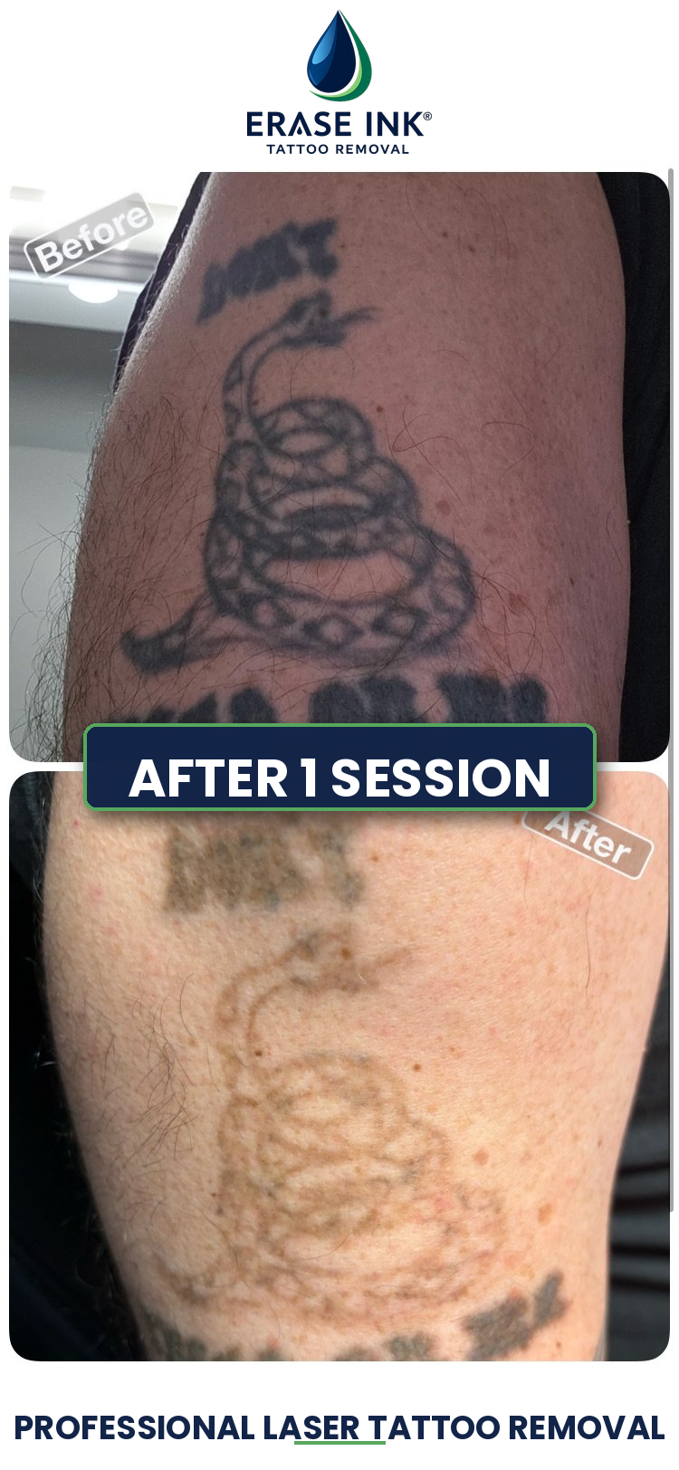 Before and after tattoo removal