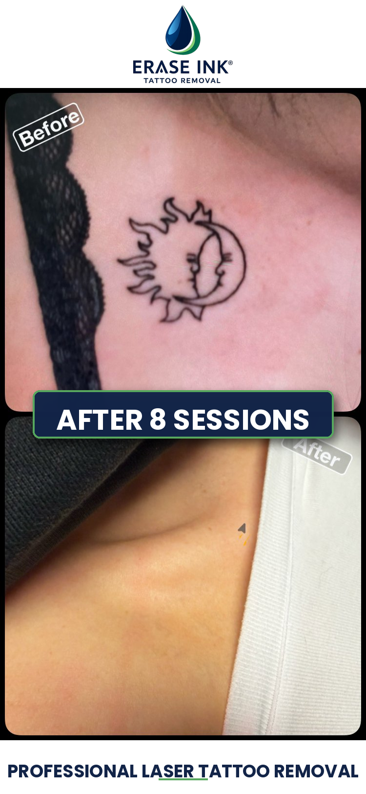 Before and after large tattoo removal